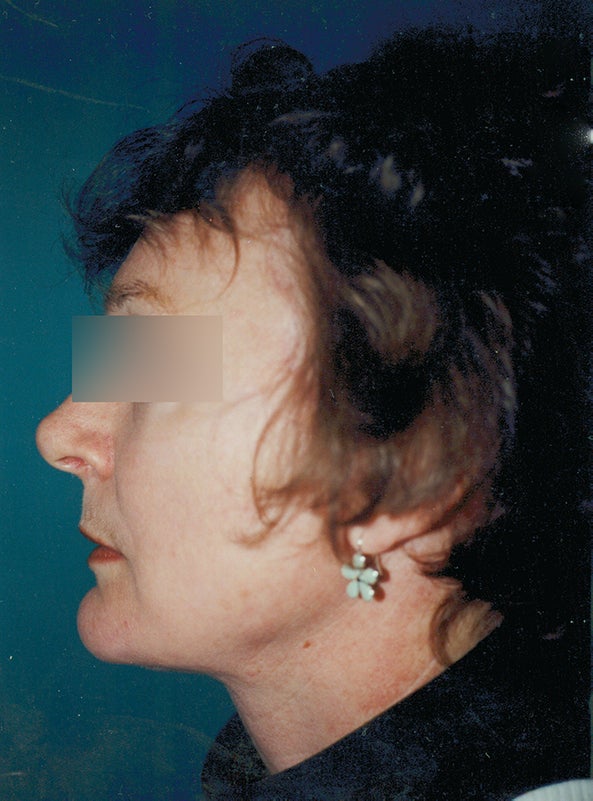Before and After