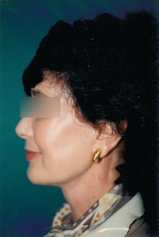 Before and After